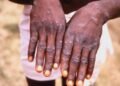Monkey Pox Scottland