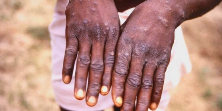 Monkey Pox Scottland