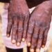 Monkey Pox Scottland